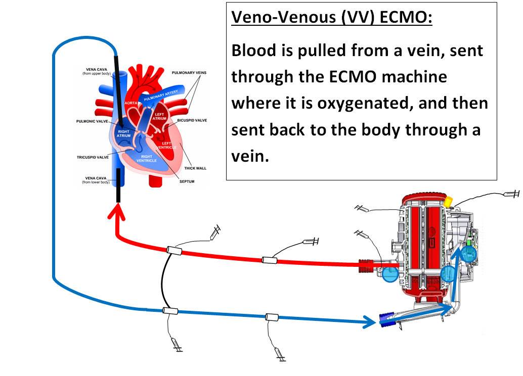 Diagram displaying VV ECMO. Blood is pulled from a vein, sent through the ECMO machine where it is oxgenated, and then sent back to the body via an artery.